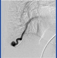 Hereditary Hemorrhagic Telangiectasia (HHT) scan